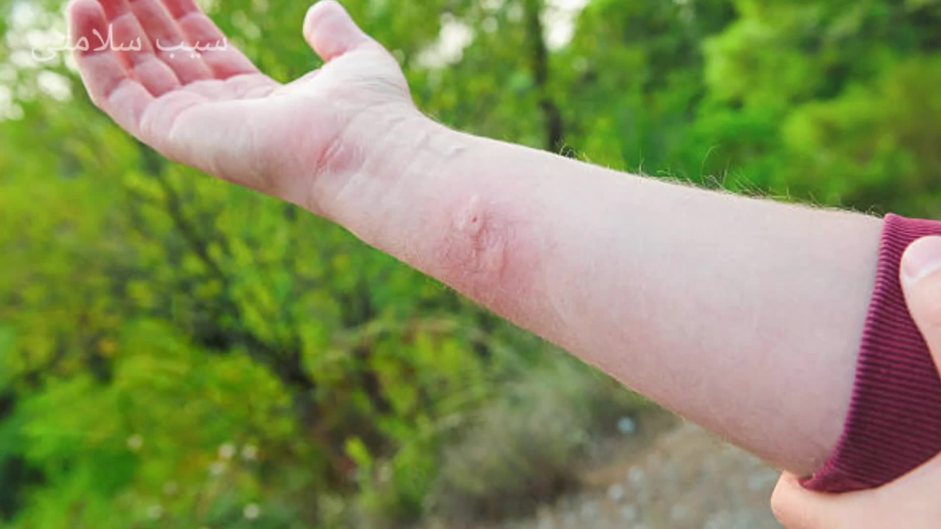 پوستر نیش حشرات